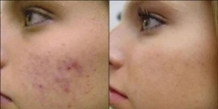 Chemický peeling SynCare - omlazující péče, léčba akné, hyperpigmentace a jiných nedokonalostí