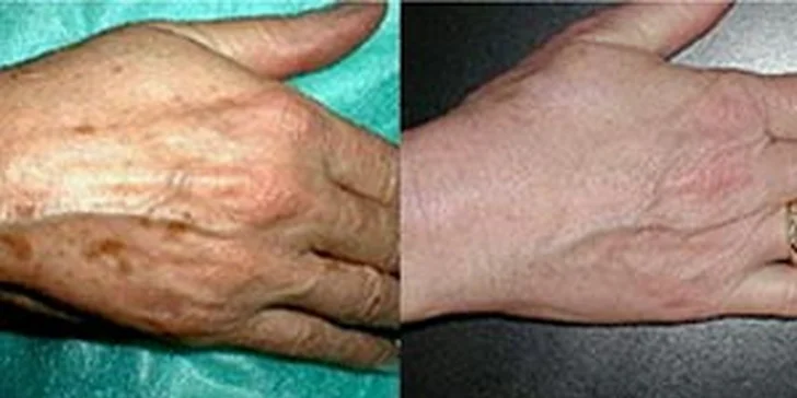 Chemický peeling SynCare - omlazující péče, léčba akné, hyperpigmentace a jiných nedokonalostí