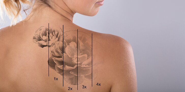 Laserové odstranění tetování či permanentního make-upu