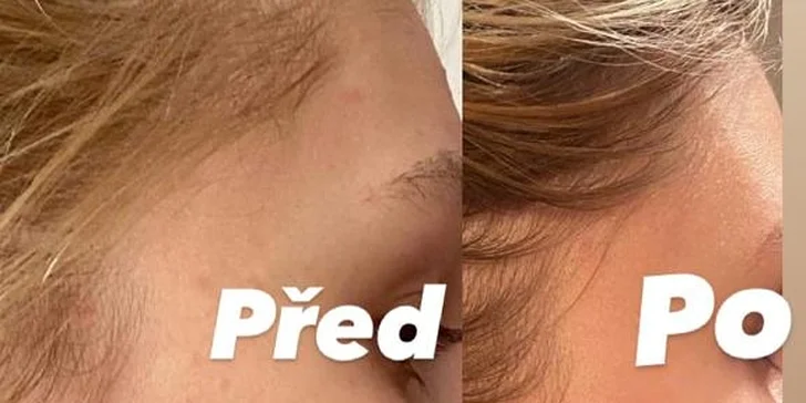 Výsledky ošetření aknózní pleti.
