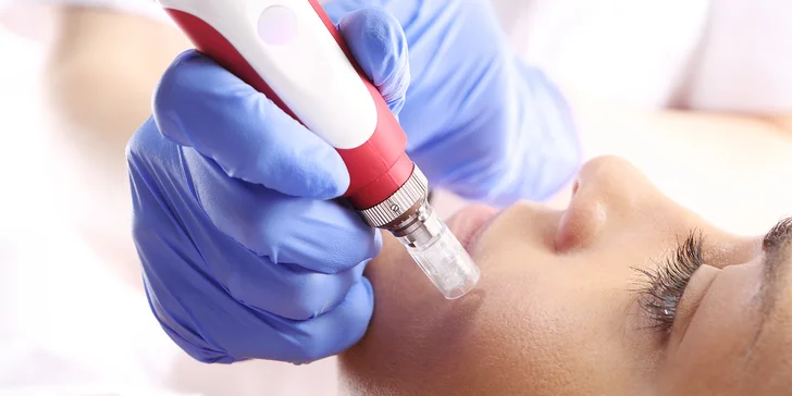 Mezoterapie obličeje nebo dekoltu s kyselinou hyaluronovou a smĕsí vitamínů