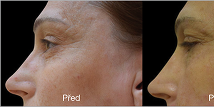 Omlazení obličeje, krku a dekoltu mezoterapií s 2–8% kys. hyaluronovou nebo liftingovým sérem