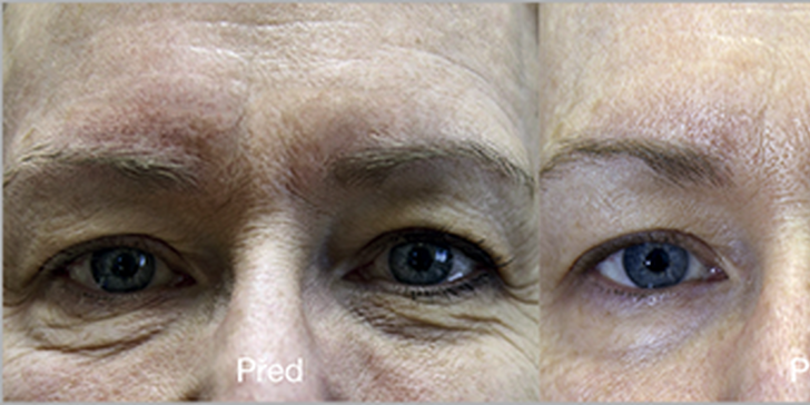Plazmaterapie pro omlazení pleti: 1 či 2 aplikace na obličej, krk nebo dekolt