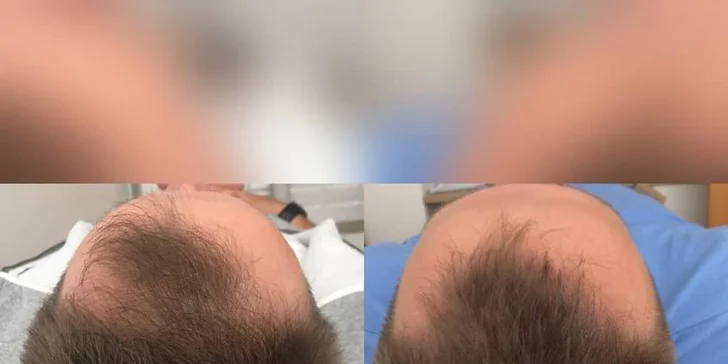 Tetování vlasů mikropigmentací: maskování koutů, kolečka na temeni atd.