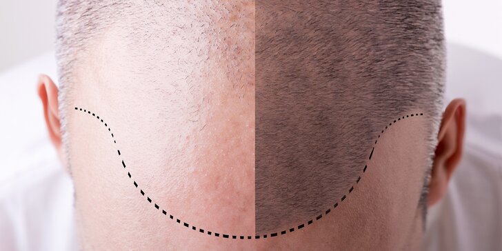 Tetování vlasů mikropigmentací: maskování koutů, kolečka na temeni atd.