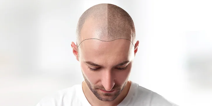 Tetování vlasů mikropigmentací: maskování koutů, kolečka na temeni atd.