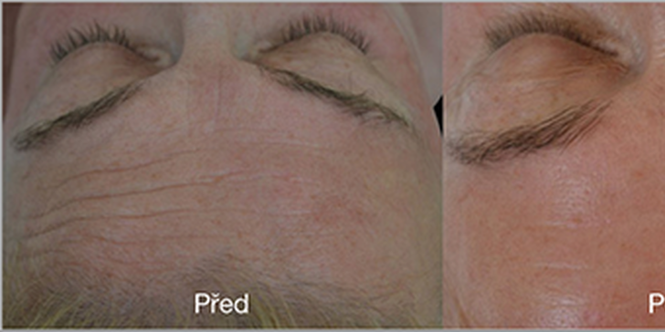 Omlazení obličeje, krku a dekoltu mezoterapií s 2–8% kys. hyaluronovou nebo liftingovým sérem