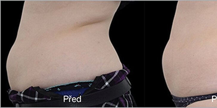 Injekční lipolýza: vypnutí a odstranění podbradku či redukce tuku stehen i bříška