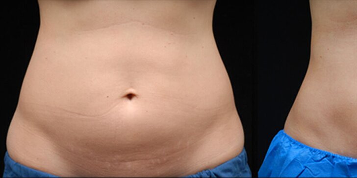 Kryolipolýza: bezbolestná neinvazivní liposukce i s lymfodrenáží