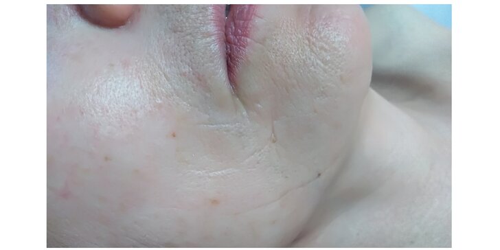 Bezjehličková mezoterapie obličeje, krku a dekoltu i s kolagenovými nitěmi
