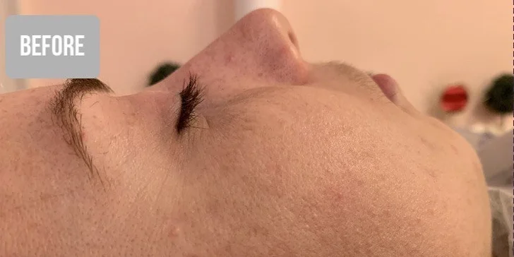 Ultrazvukové čištění pleti, anti-age peeling nebo omlazující kúra dle výběru