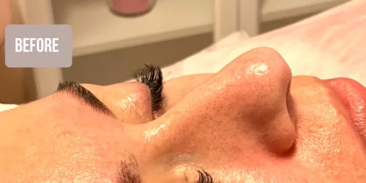 Ultrazvukové čištění pleti, anti-age peeling nebo omlazující kúra dle výběru