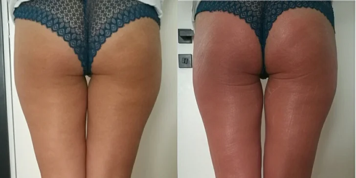 Express Slimming: tělové ošetření zaměřené na celulitidu, až 5 návštěv