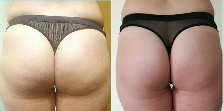 Express Slimming: tělové ošetření zaměřené na celulitidu, až 5 návštěv