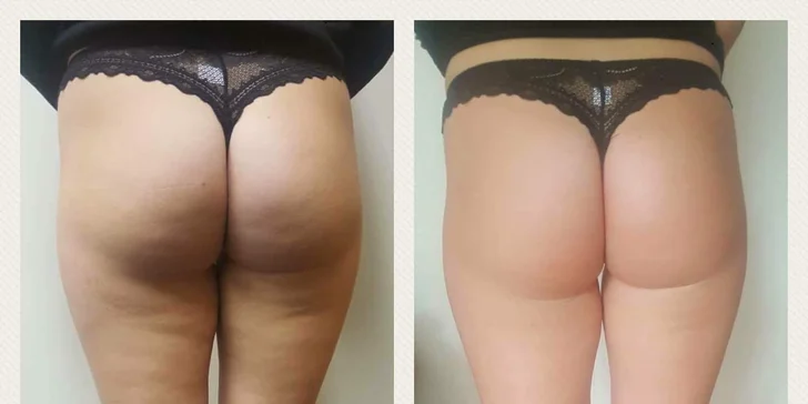 Express Slimming: tělové ošetření zaměřené na celulitidu, až 5 návštěv