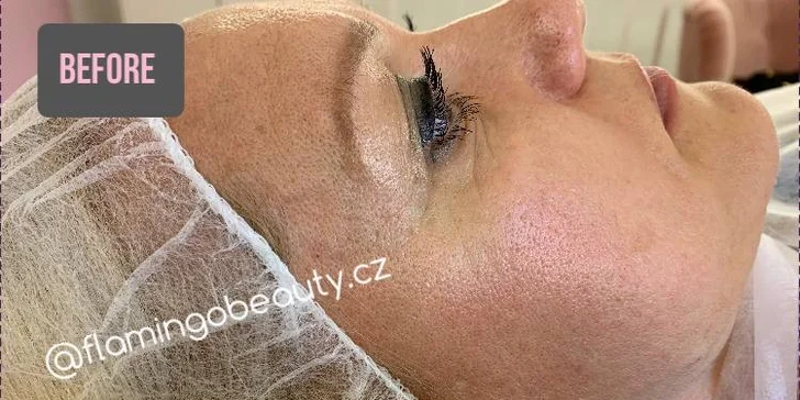 Ultrazvukové čištění pleti, anti-age peeling nebo omlazující kúra dle výběru