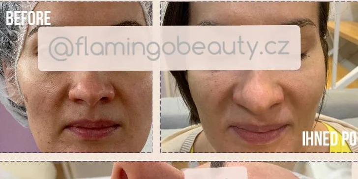 Ultrazvukové čištění pleti, anti-age peeling nebo omlazující kúra dle výběru