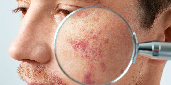 Zdravá pleť: hloubkové čištění i aplikace IPL proti akné na obličeji, ramenou i zádech