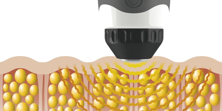 Ošetření rázovou vlnou proti celulitidě