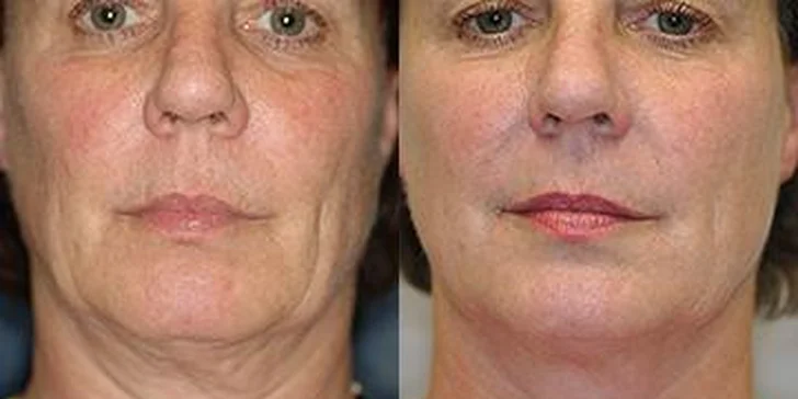 Thermage se systémem CPT - nejžádanější liftingový zákrok roku