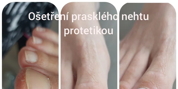 Pečujte o vaše nožky: Zdravotní suchá pedikúra s peelingem a nehtovou protetikou