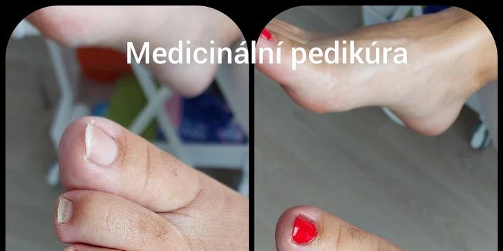 Pečujte o vaše nožky: Zdravotní suchá pedikúra s peelingem a nehtovou protetikou