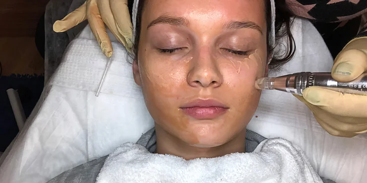Dermapen ošetření BB Glow: zapracování barevného séra s pigmentem ke sjednocení pleti