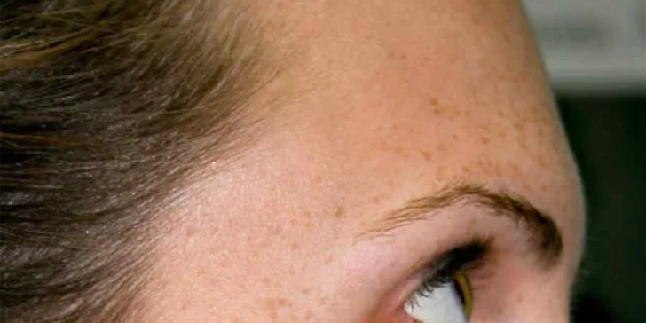 Chemický peeling proti vráskám, pigmentaci i zmírnění akné