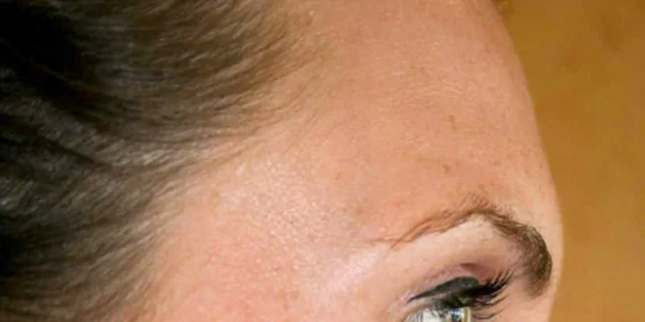 Chemický peeling proti vráskám, pigmentaci i zmírnění akné