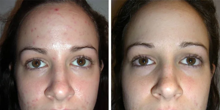 Chemický peeling proti vráskám, pigmentaci i zmírnění akné