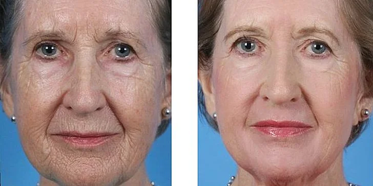 Chemický peeling proti vráskám, pigmentaci i zmírnění akné