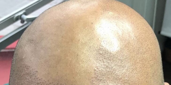 Zahuštění vlasů pomocí mikropigmentace pro muže i ženy: kouty i celá hlava