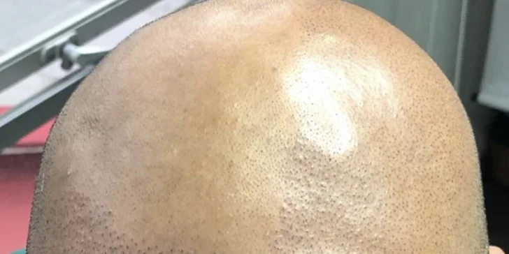 Zahuštění vlasů pomocí mikropigmentace pro muže i ženy: kouty i celá hlava