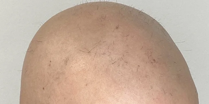 Zahuštění vlasů pomocí mikropigmentace pro muže i ženy: kouty i celá hlava