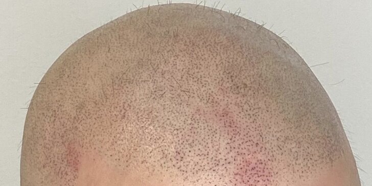 Zahuštění vlasů pomocí mikropigmentace pro muže i ženy: kouty i celá hlava