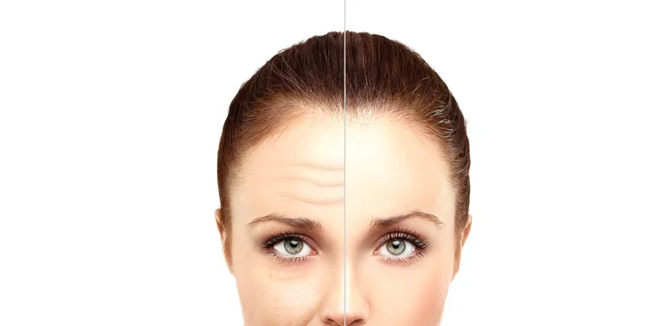 Botox - korekce mimických vrásek