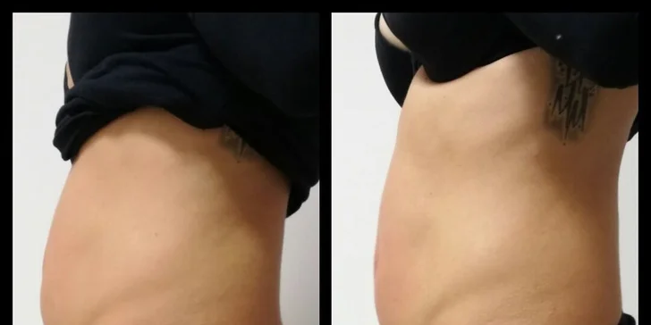 Výsledek ošetření po 3 aplikacích ultrazvukové liposukce