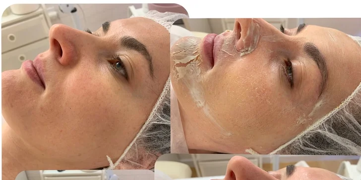 Ultrazvukové čištění pleti, anti-age peeling nebo omlazující kúra dle výběru