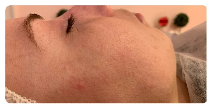 Ultrazvukové čištění pleti, anti-age peeling nebo omlazující kúra dle výběru