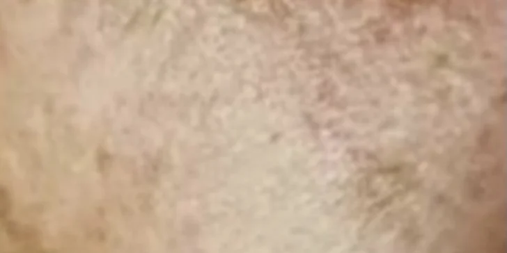 Ultrazvukové čištění pleti, anti-age peeling nebo omlazující kúra dle výběru