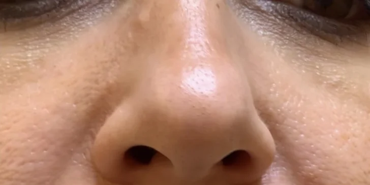 Ultrazvukové čištění pleti, anti-age peeling nebo omlazující kúra dle výběru