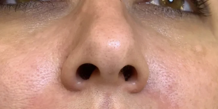 Ultrazvukové čištění pleti, anti-age peeling nebo omlazující kúra dle výběru