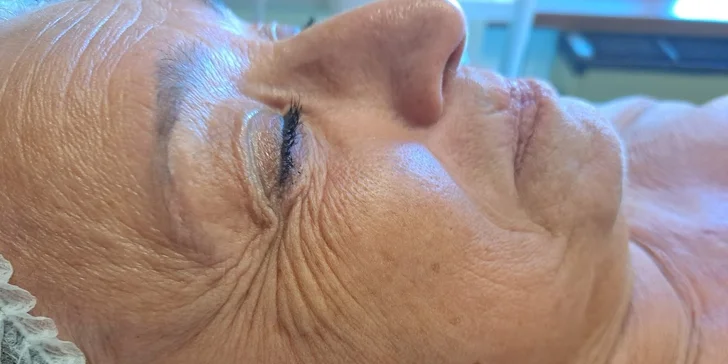 Mikrojehličková mezoterapie dekoltu, podbradku, krku i obličeje