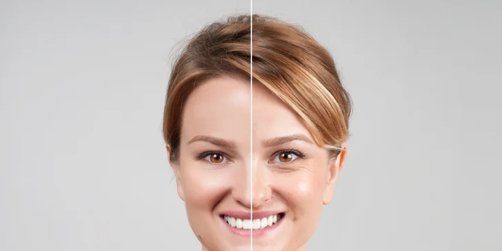 Chemický peeling pro sjednocení a vyhlazení pleti i zmírnění projevů akné