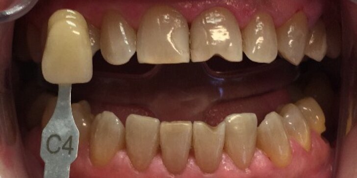 White Dental Beauty sada na domácí bělení zubů vč. konzultace