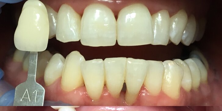 White Dental Beauty sada na domácí bělení zubů vč. konzultace