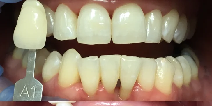 White Dental Beauty sada na domácí bělení zubů vč. konzultace