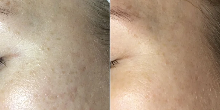 Laminace, lash lifting řas nebo inovativní peeling BioRePeelCL3