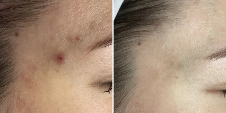 Laminace, lash lifting řas nebo inovativní peeling BioRePeelCL3