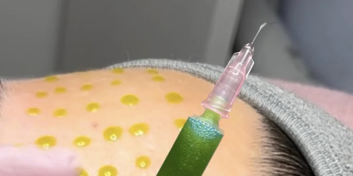 Laminace, lash lifting řas nebo inovativní peeling BioRePeelCL3